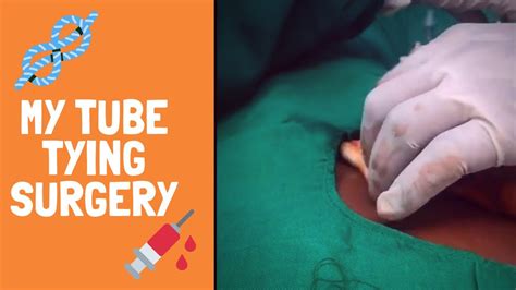 Find Out How Close You Are to Getting Tubes Tied Surgery!